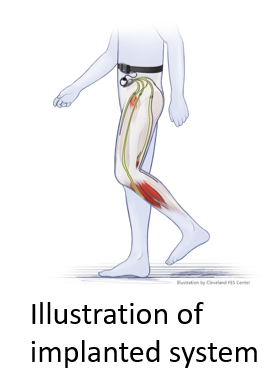 Illustration of implanted system