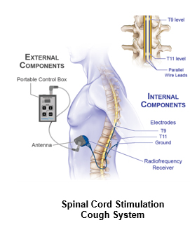 Diagram of spinal cord stimulation cough system